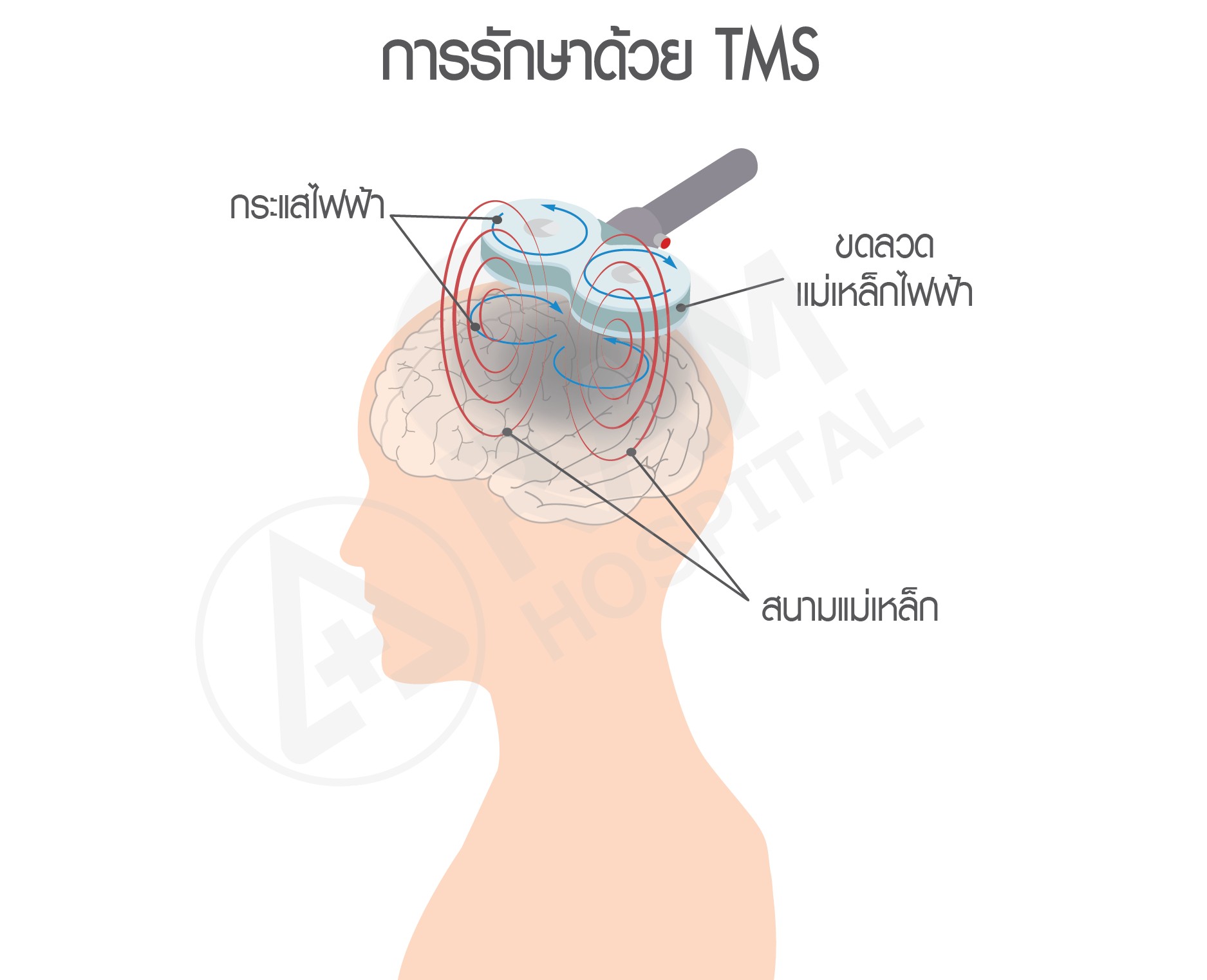 อัมพาต รักษา