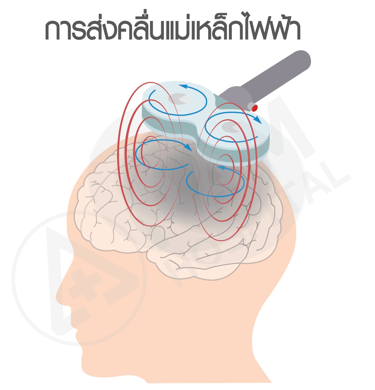 อัมพาต รักษา