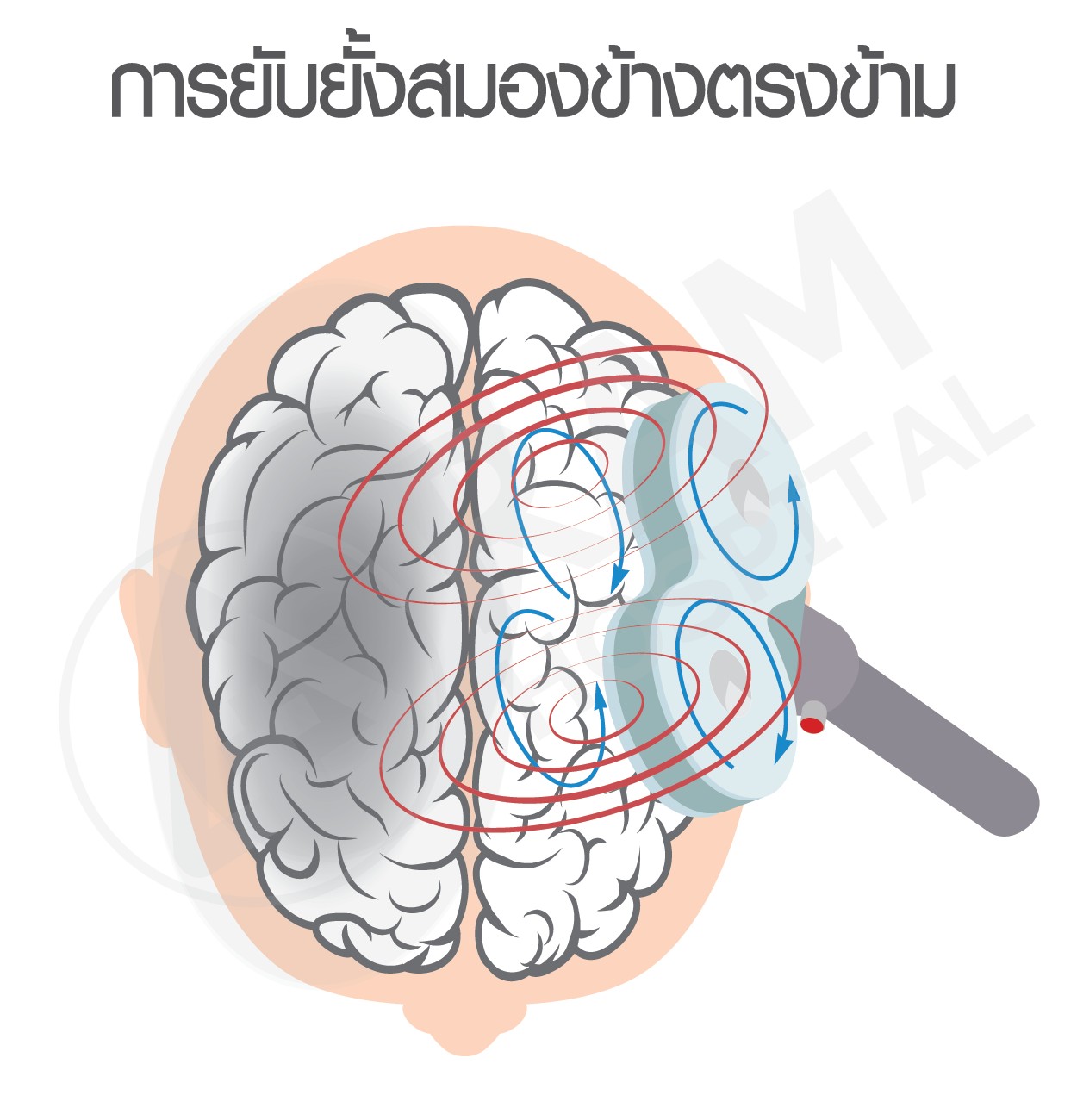 อัมพาต รักษา