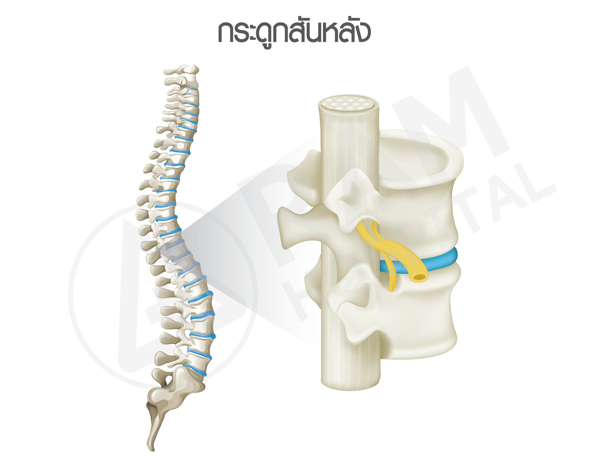 หมอนรองกระดูกทับเส้นประสาท