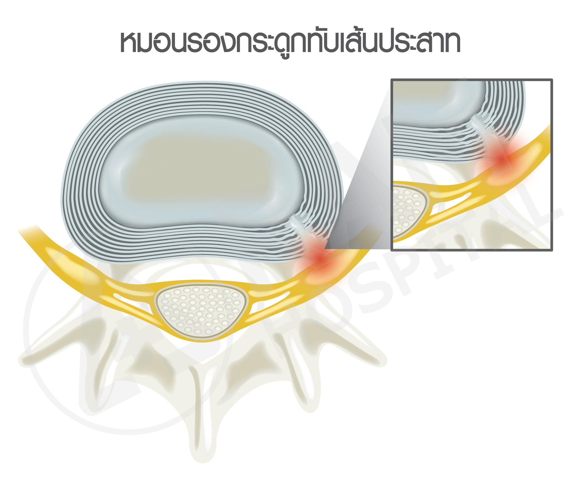 หมอนรองกระดูกทับเส้นประสาท