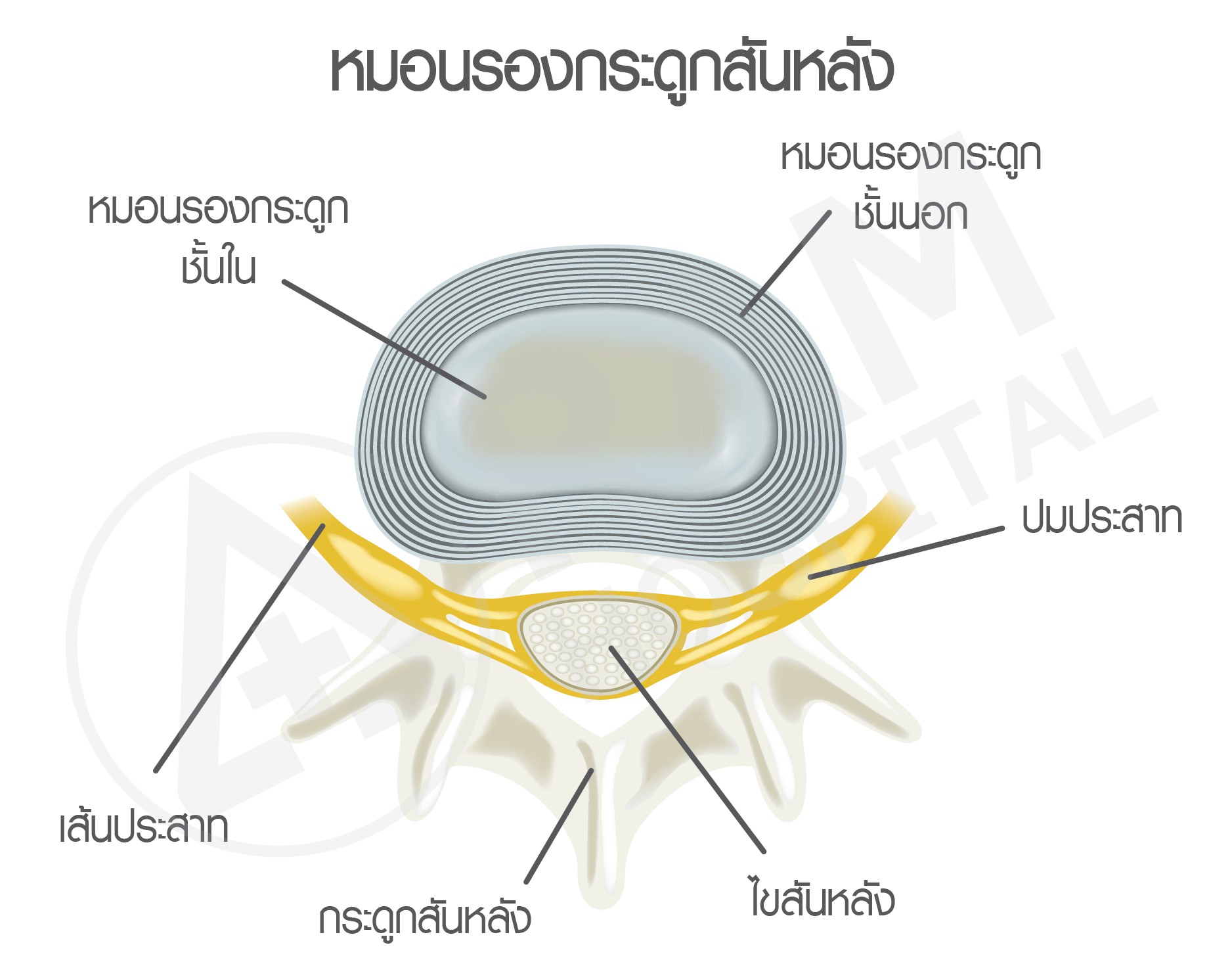 หมอนรองกระดูกทับเส้นประสาท