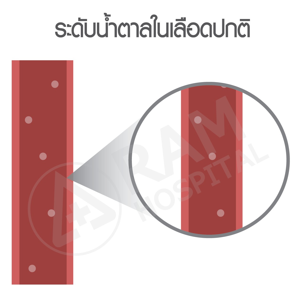 โรคเบาหวาน