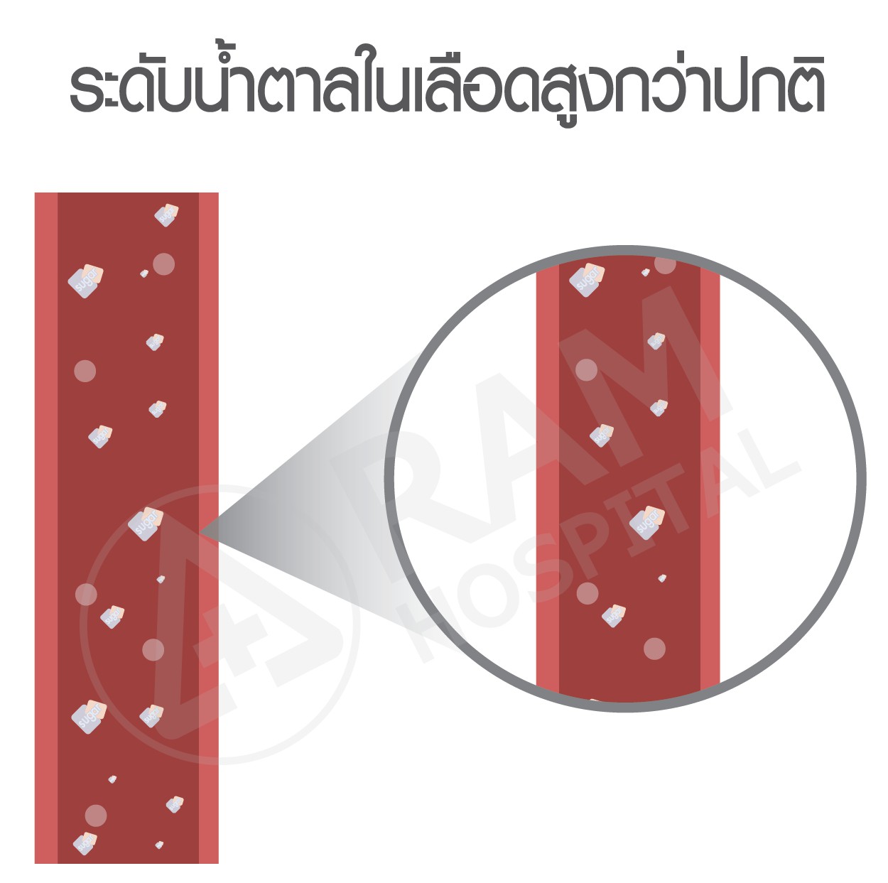 โรคเบาหวาน