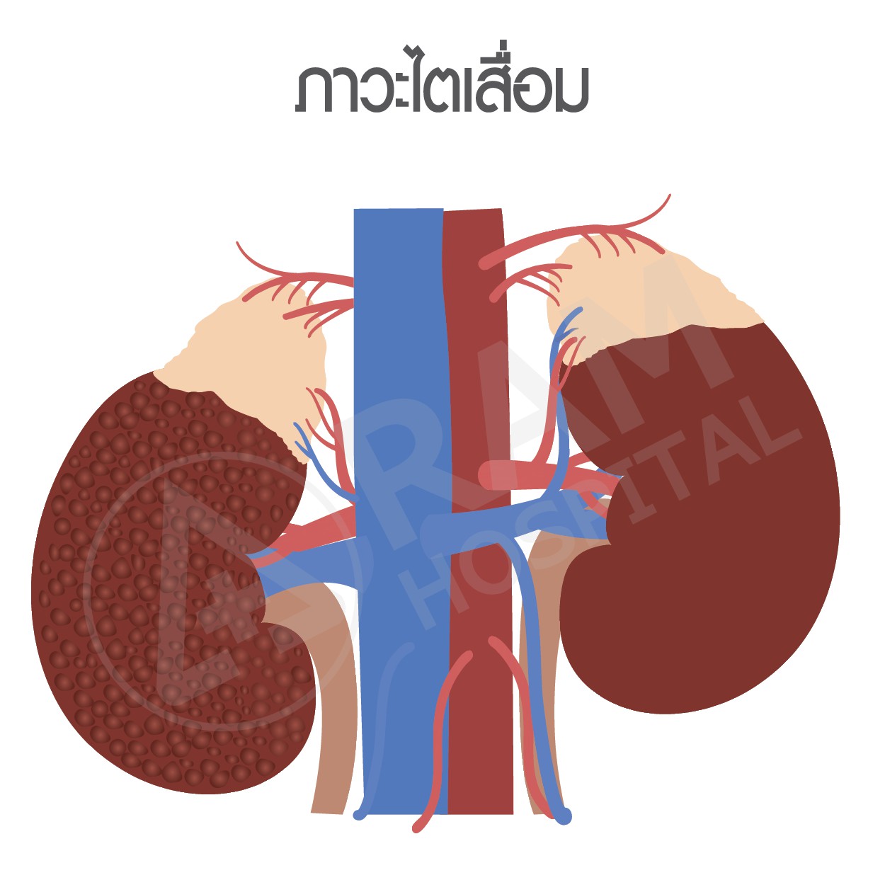 โรคเบาหวาน