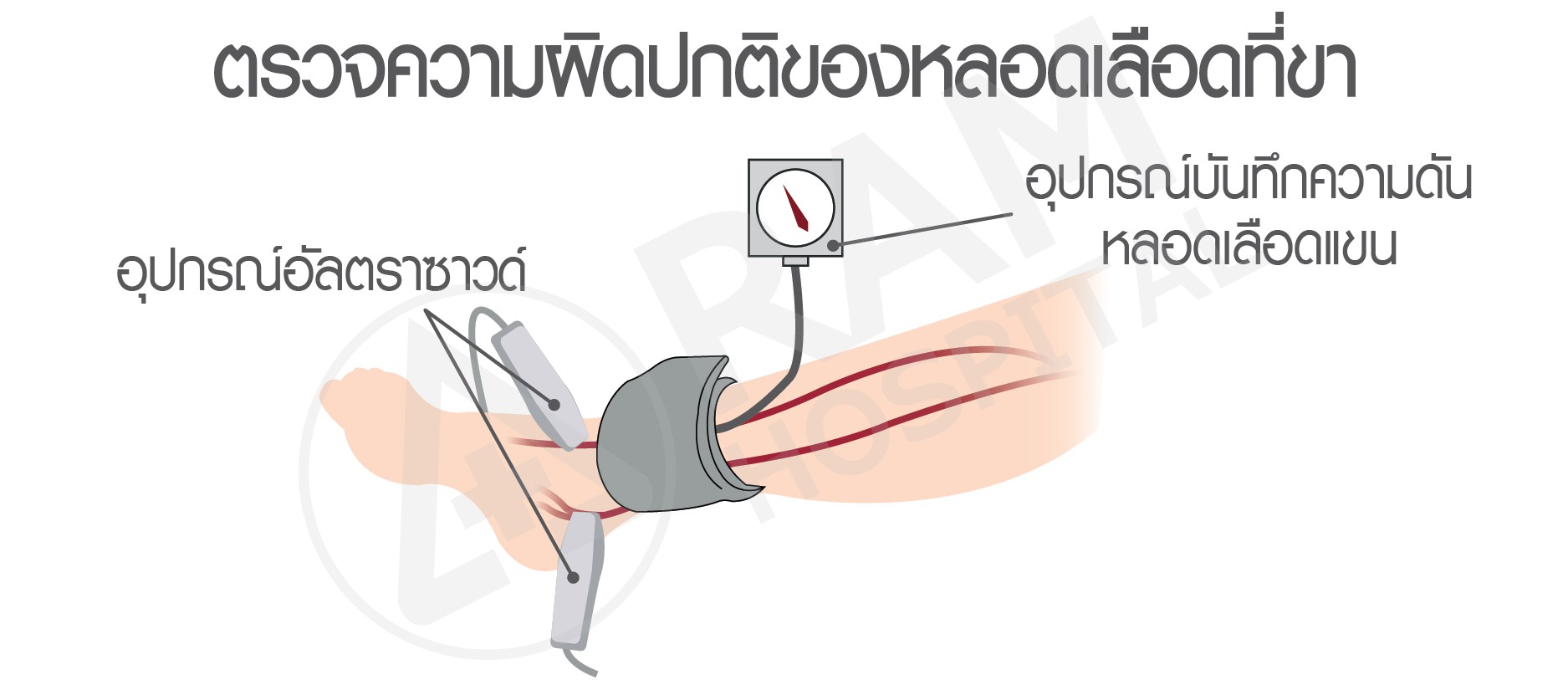 เบาหวาน หัวใจตีบ