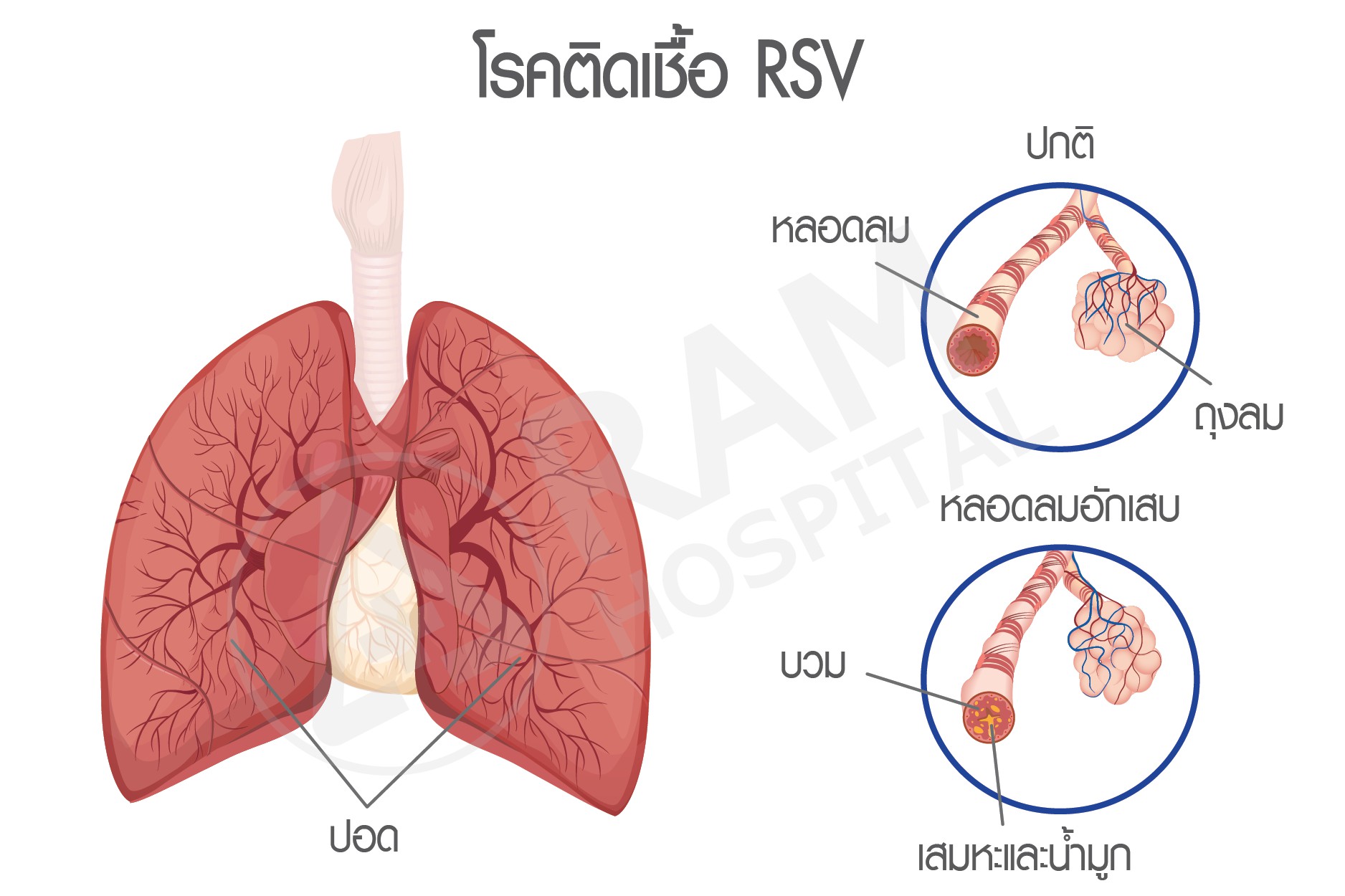 โรค rsv
