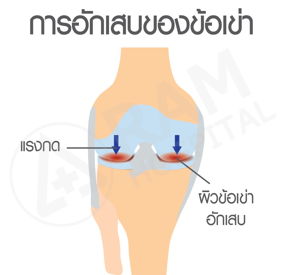 โรคข้อเข่าเสื่อม
