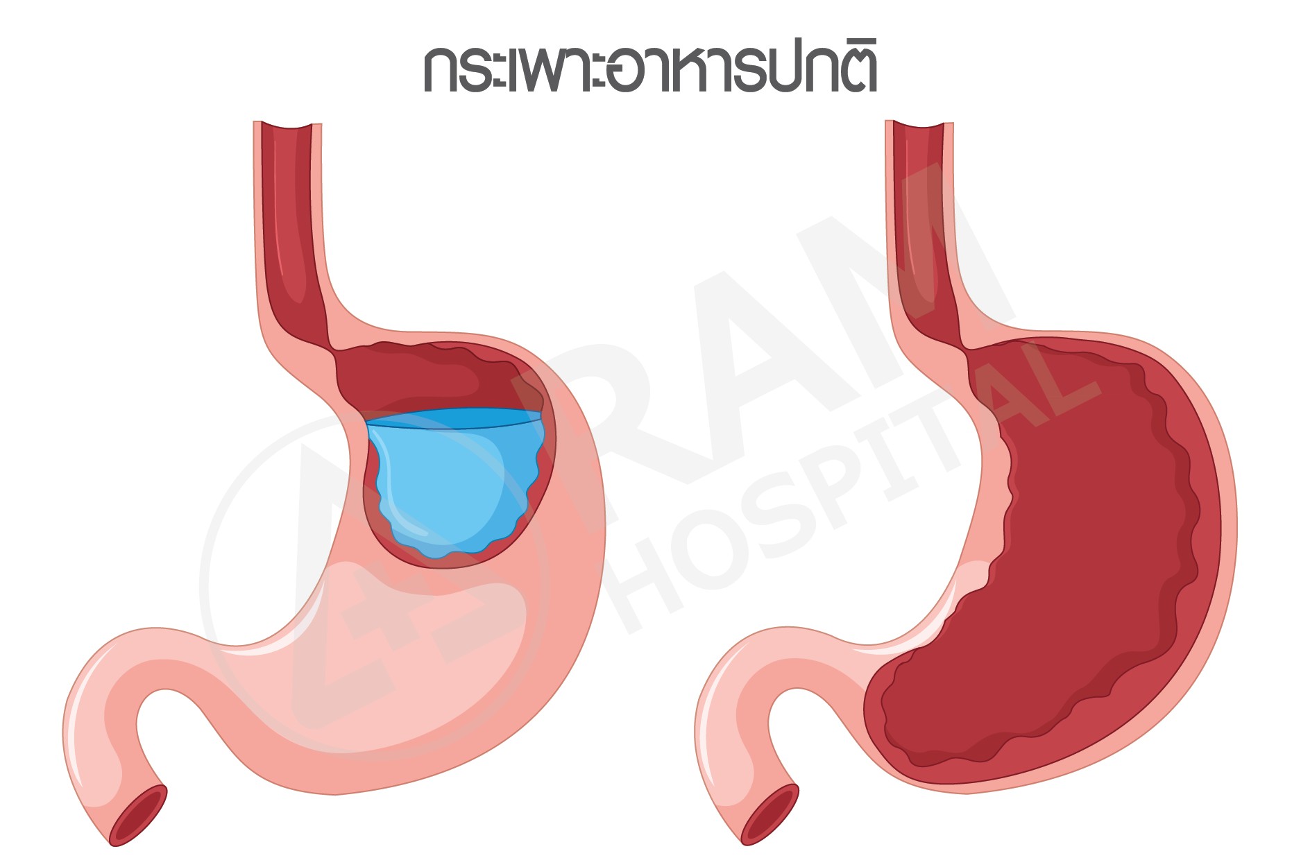 โรคแผลในกระเพาะอาหาร 