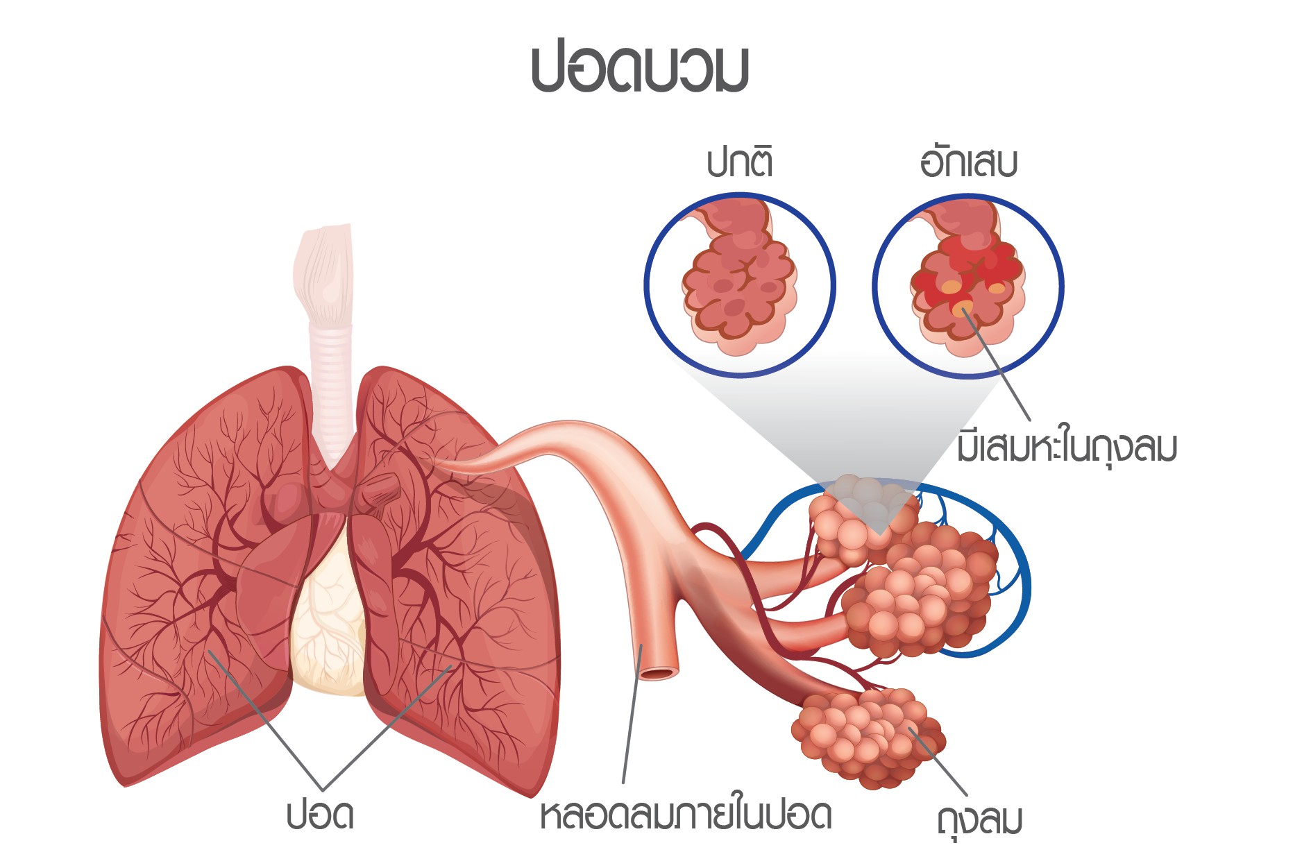 ฝุ่น pm 2.5 สุขภาพ