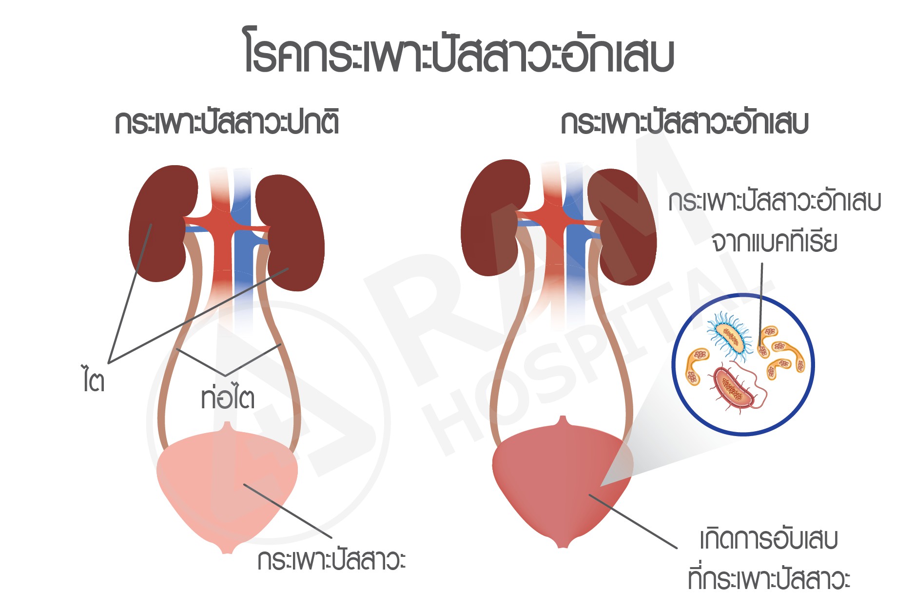โรคติดเชื้อปัสสาวะเด็ก
