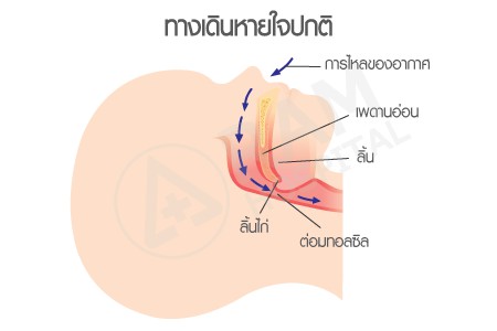 ภาวะอุดกั้นทางเดินหายใจขณะหลับในเด็ก