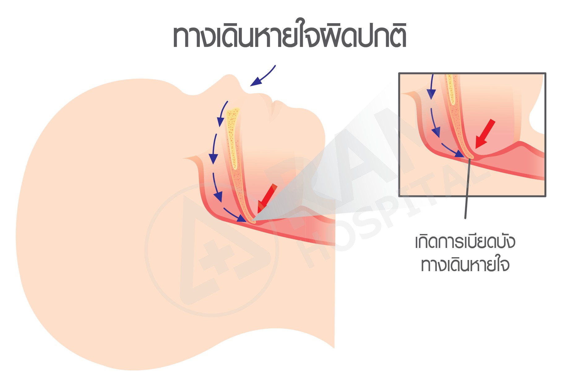 ภาวะอุดกั้นทางเดินหายใจขณะหลับในเด็ก