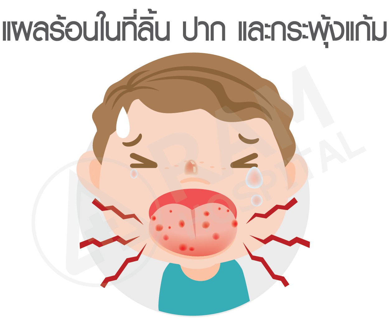 โรคมือเท้าปาก