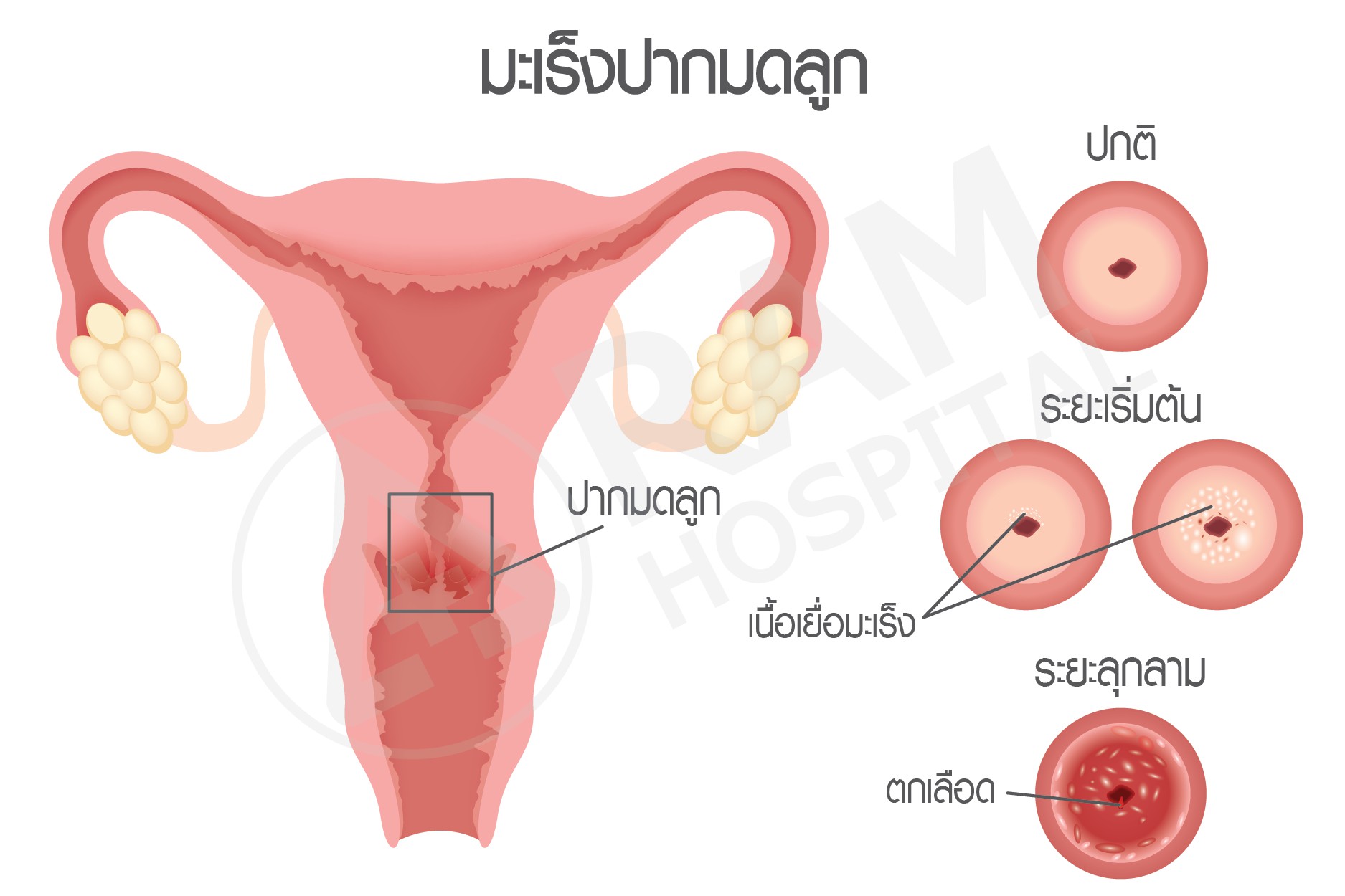 ติดเชื้อ hpv
