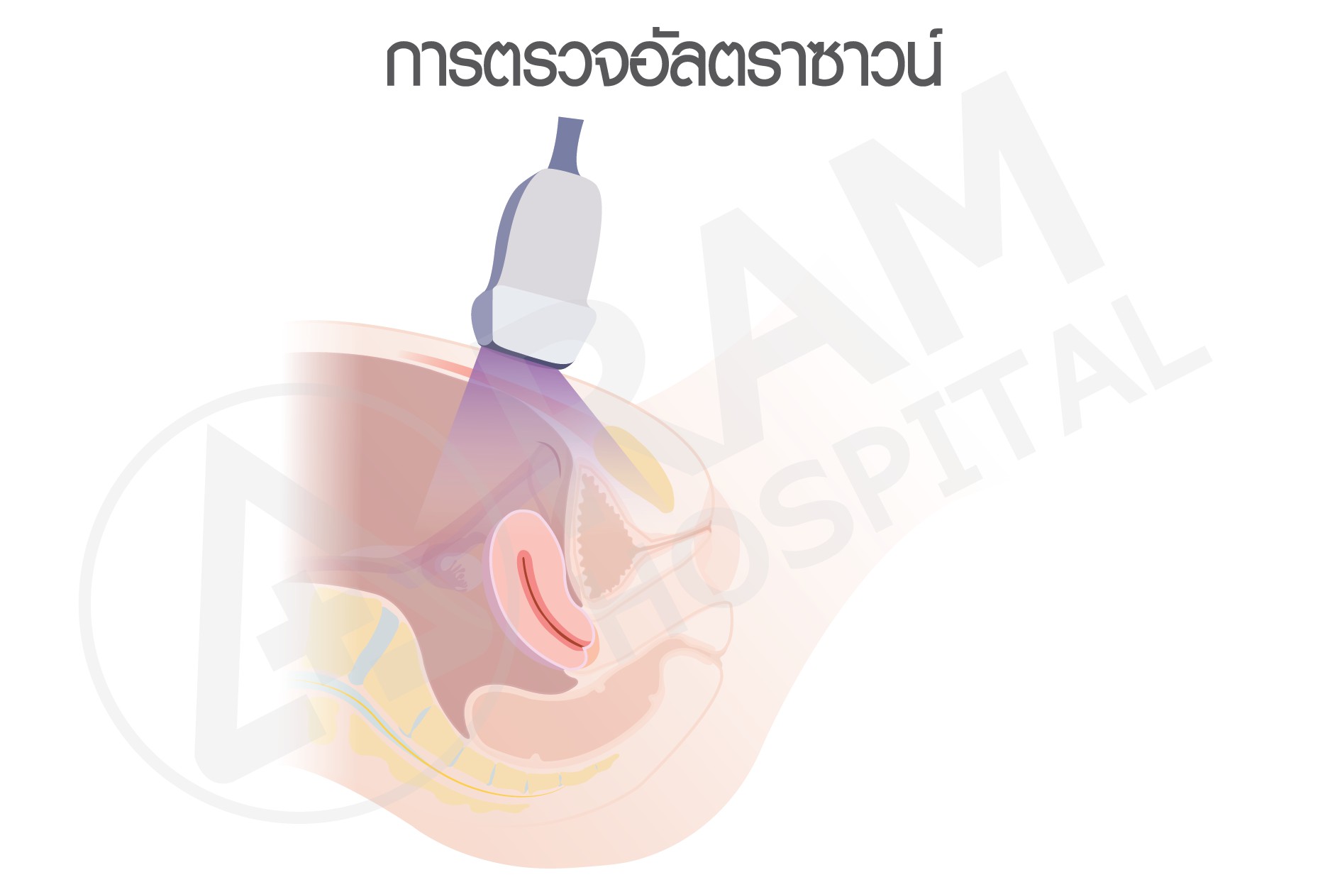 ช็อกโกแลตซีส