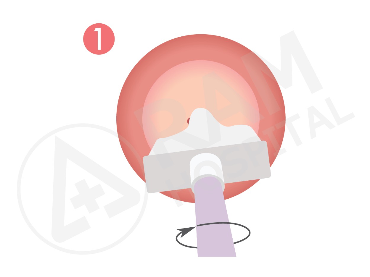 ติดเชื้อ hpv