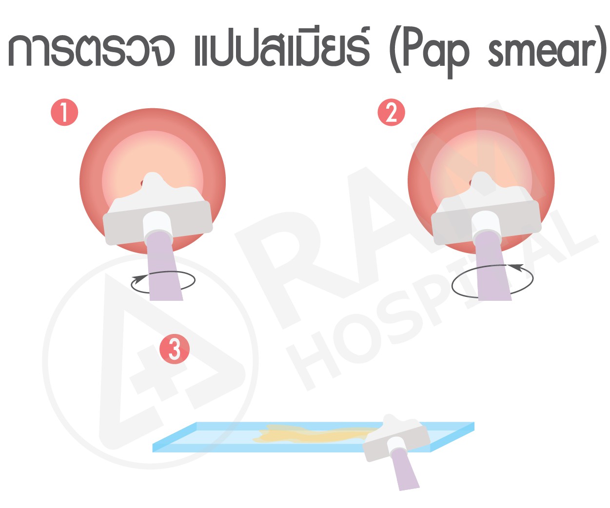 วัคซีน HPV