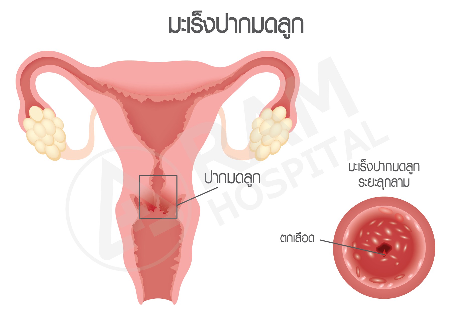 วัคซีน HPV