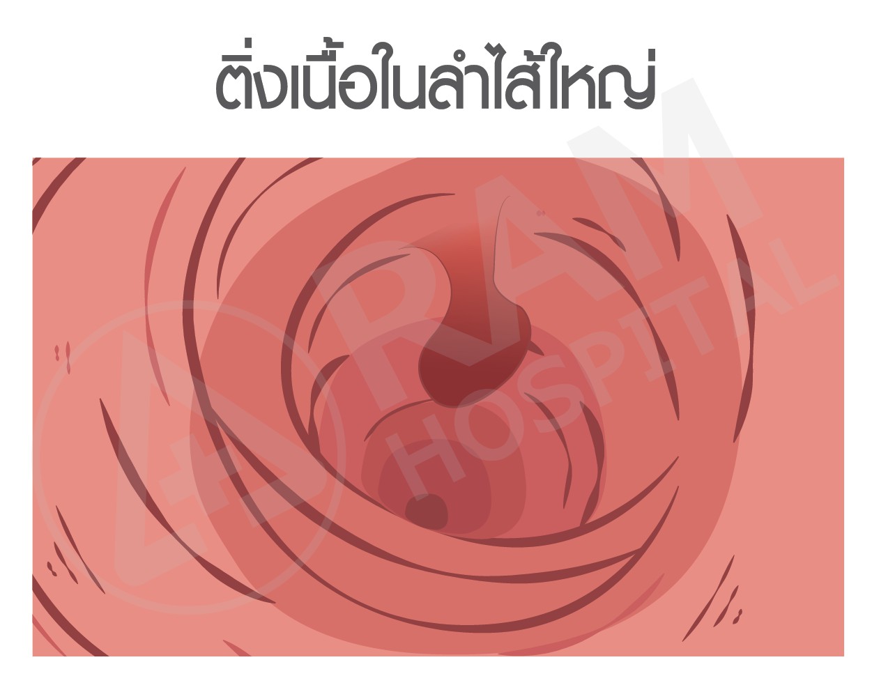 มะเร็งลำไส้ใหญ่