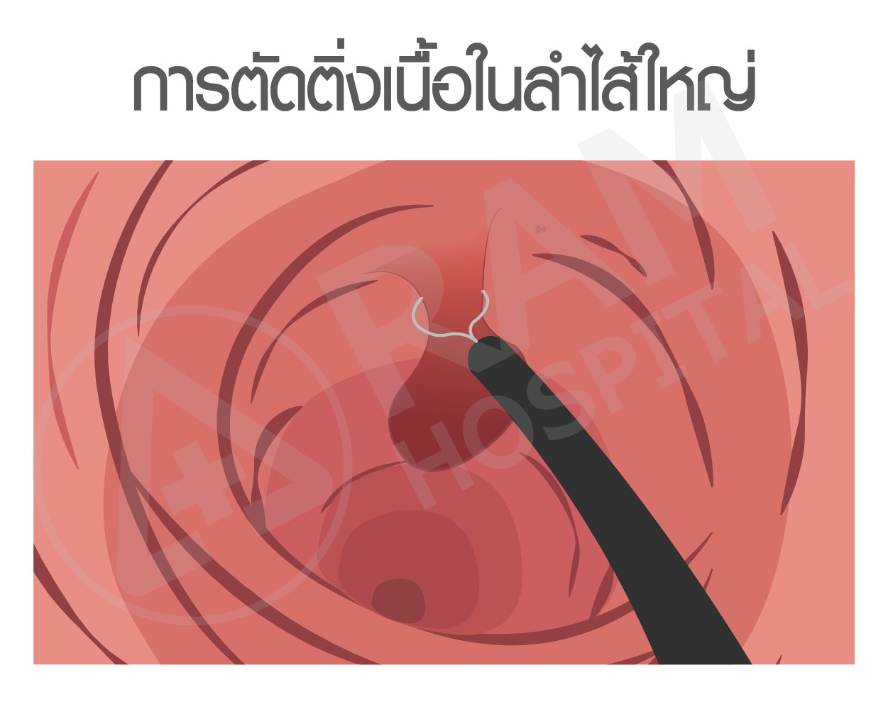 มะเร็งลำไส้ใหญ่
