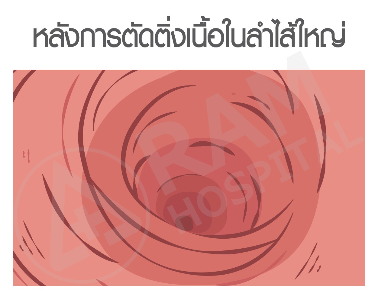 มะเร็งลำไส้ใหญ่