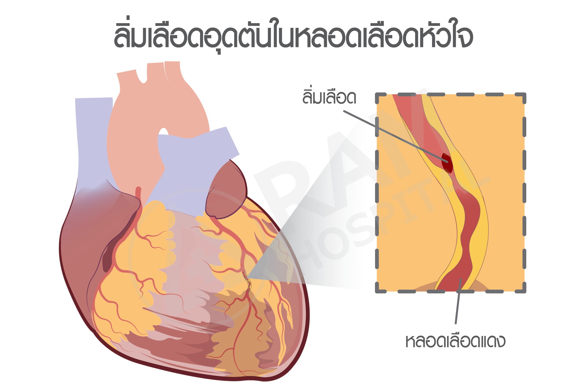 เบาหวาน โรคหัวใจ