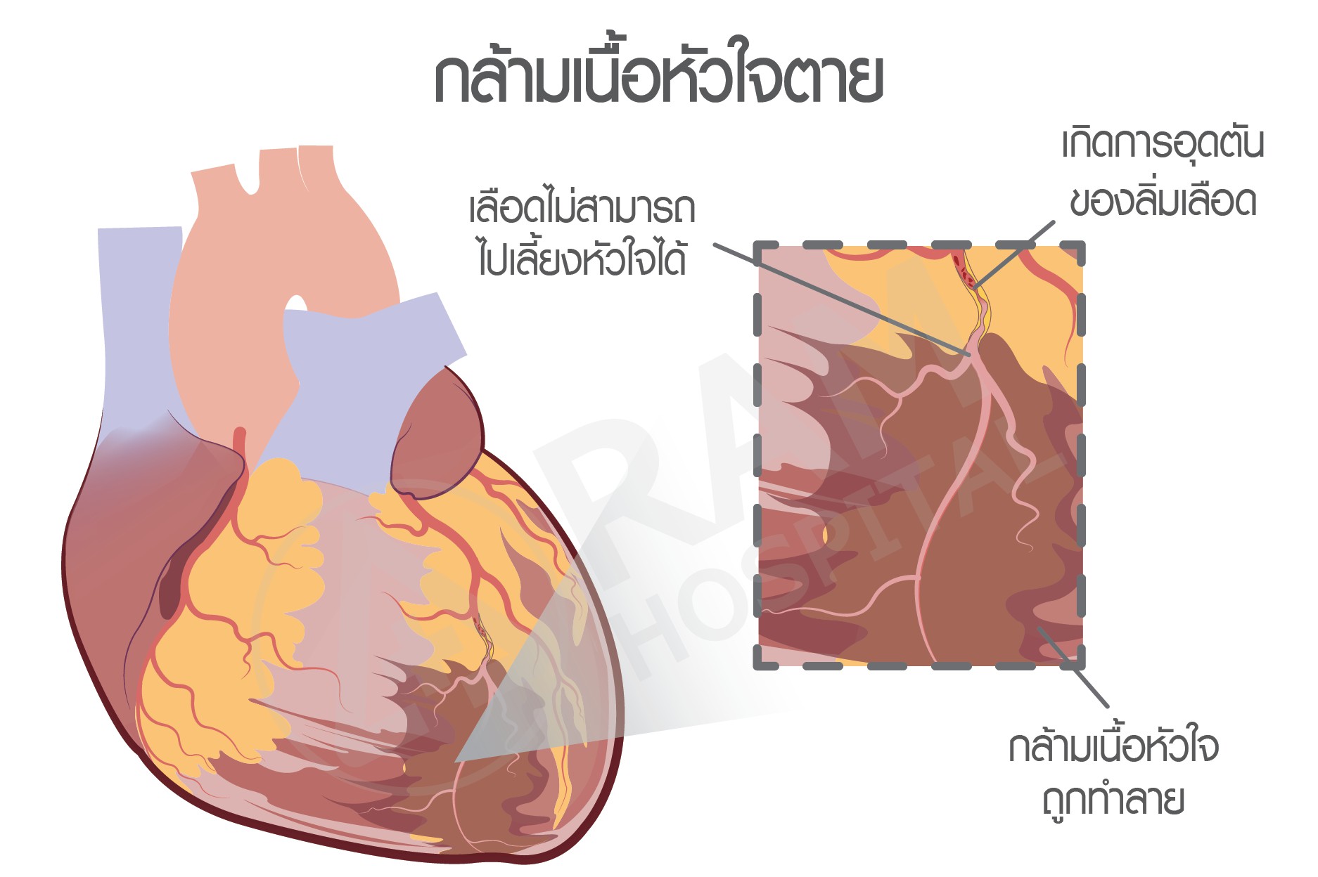 เบาหวาน โรคหัวใจ