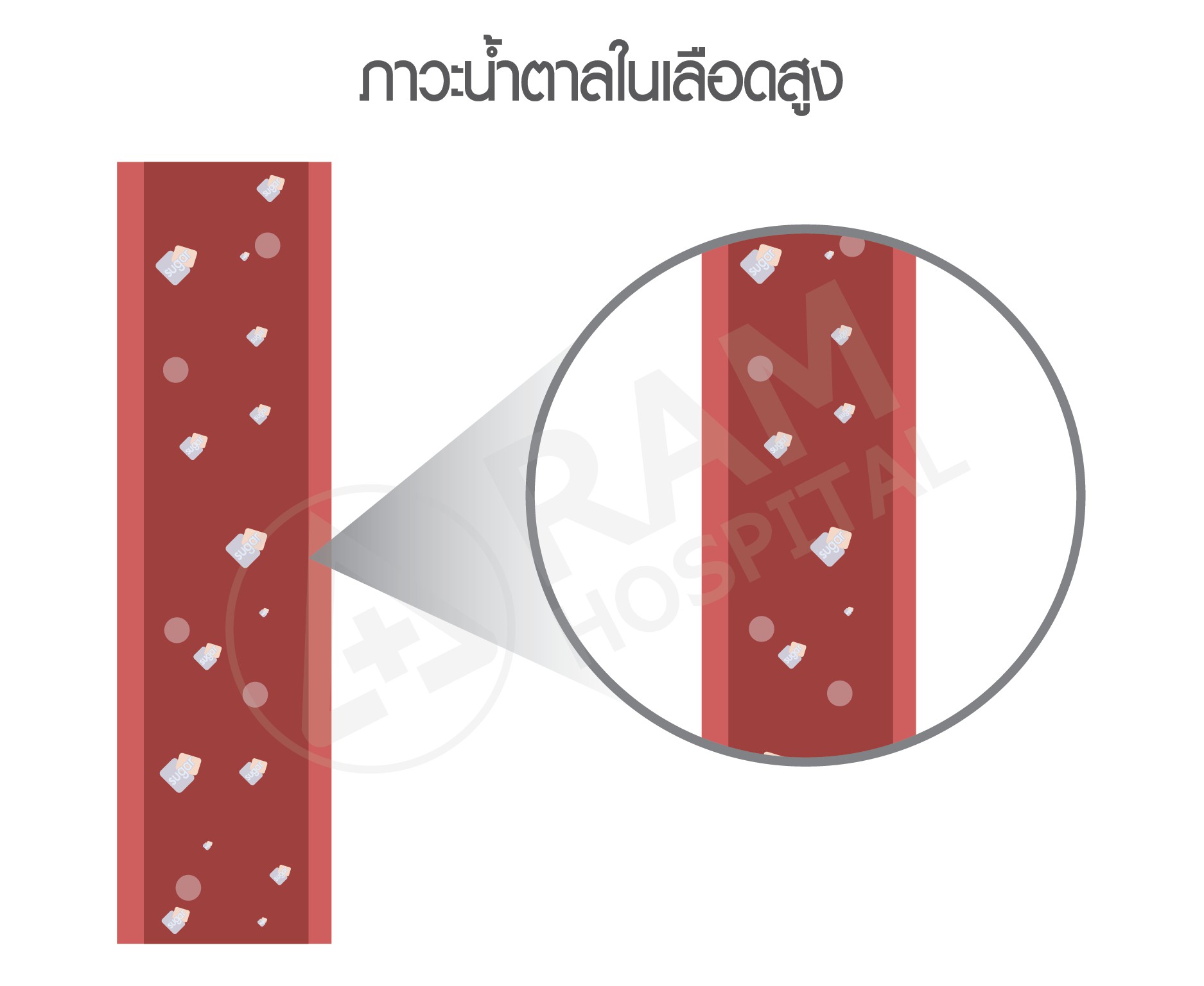 ไข้หวัดใหญ่ เบาหวาน