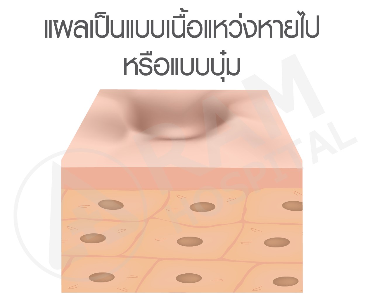 แผลเป็น