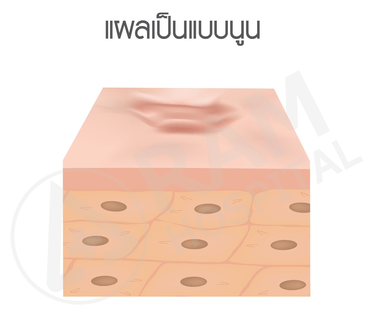 แผลเป็น