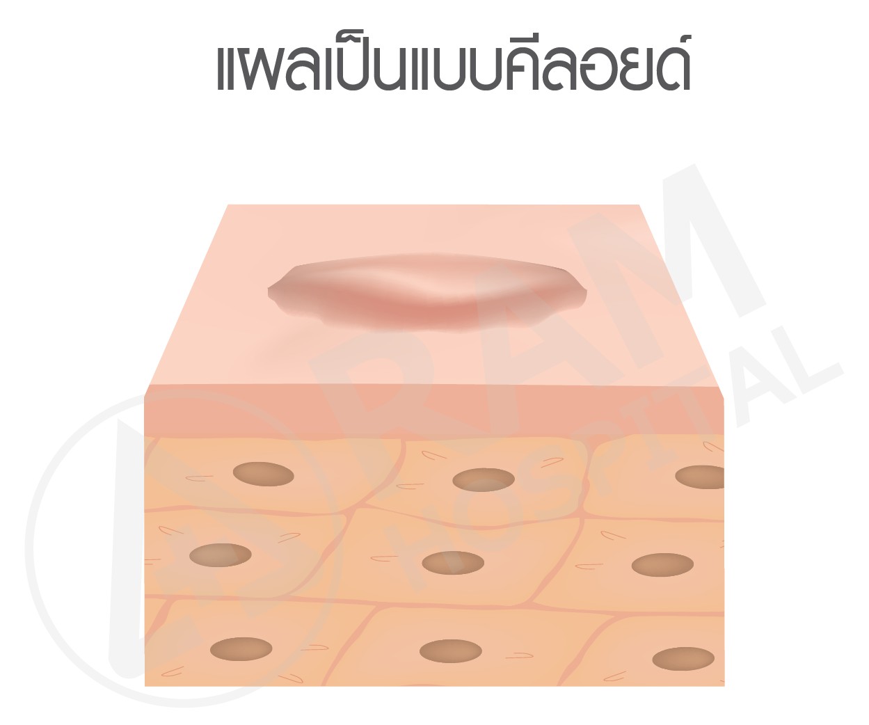 แผลเป็น