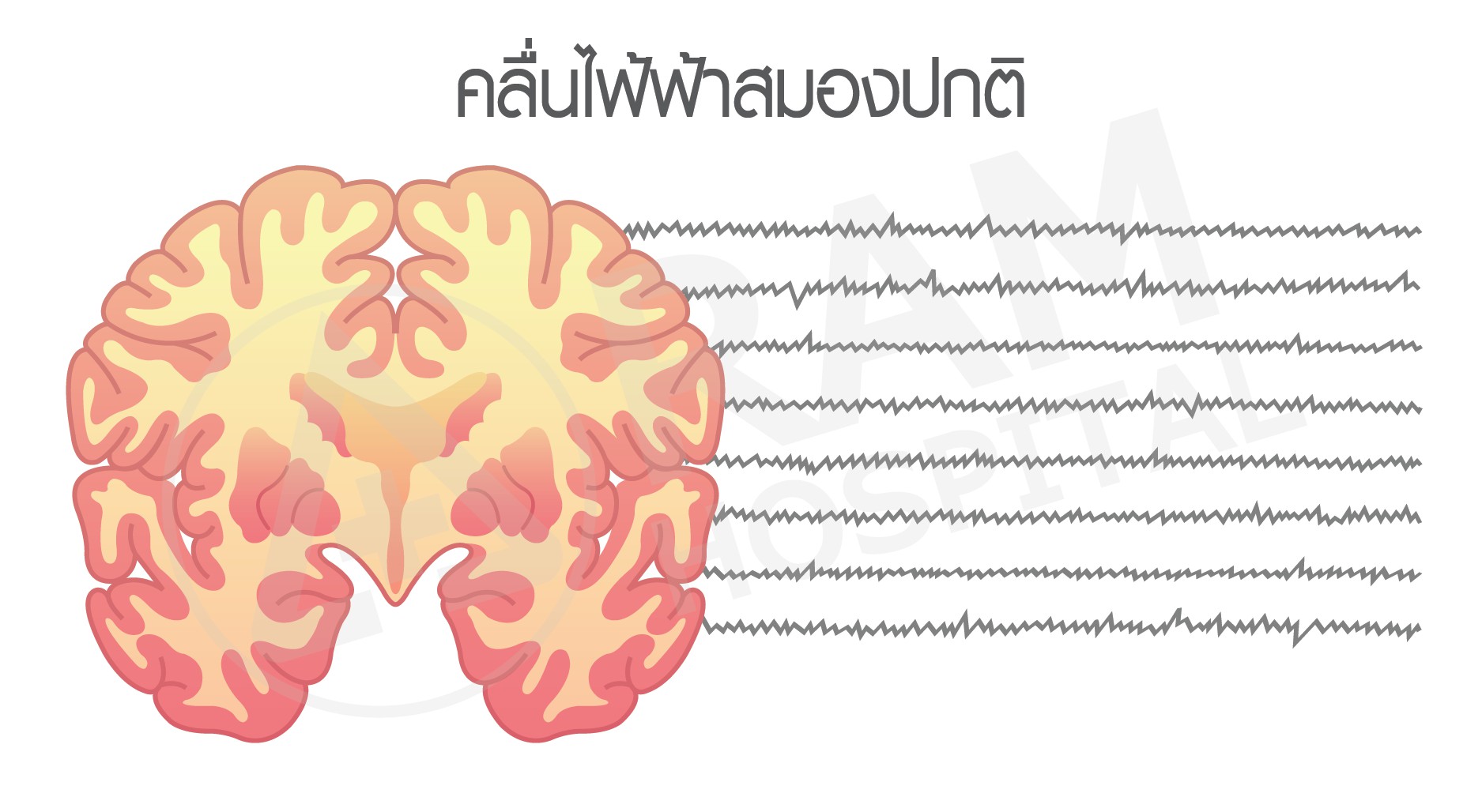 โรคลมชัก