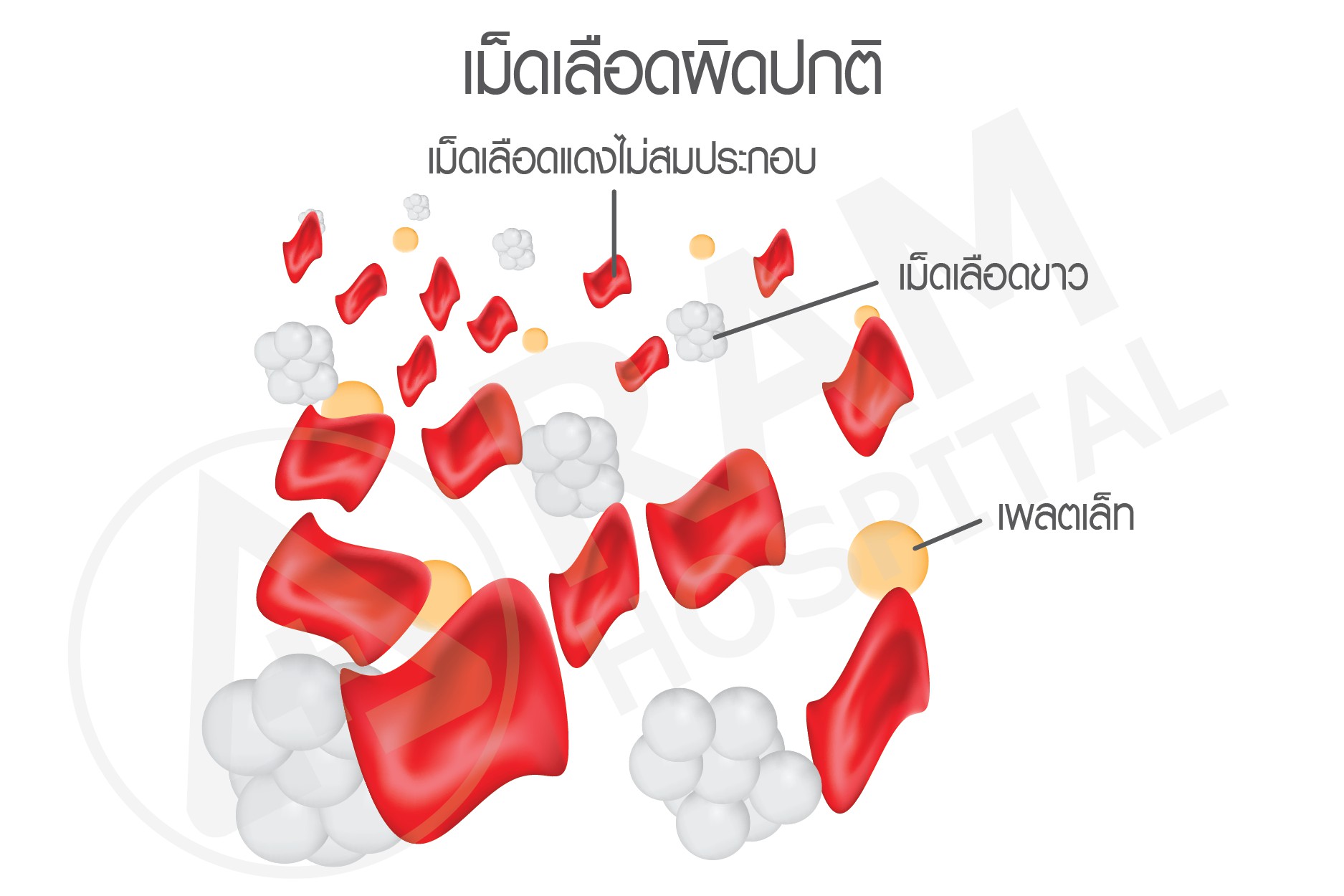 ธาลัสซ๊เมีย