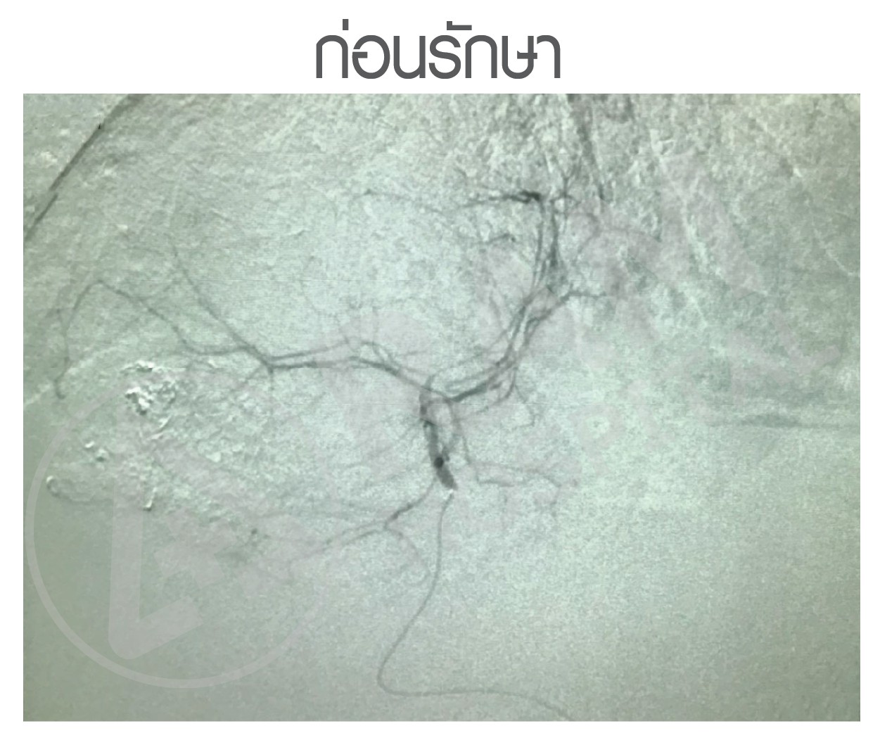 รักษามะเร็งตับ tace