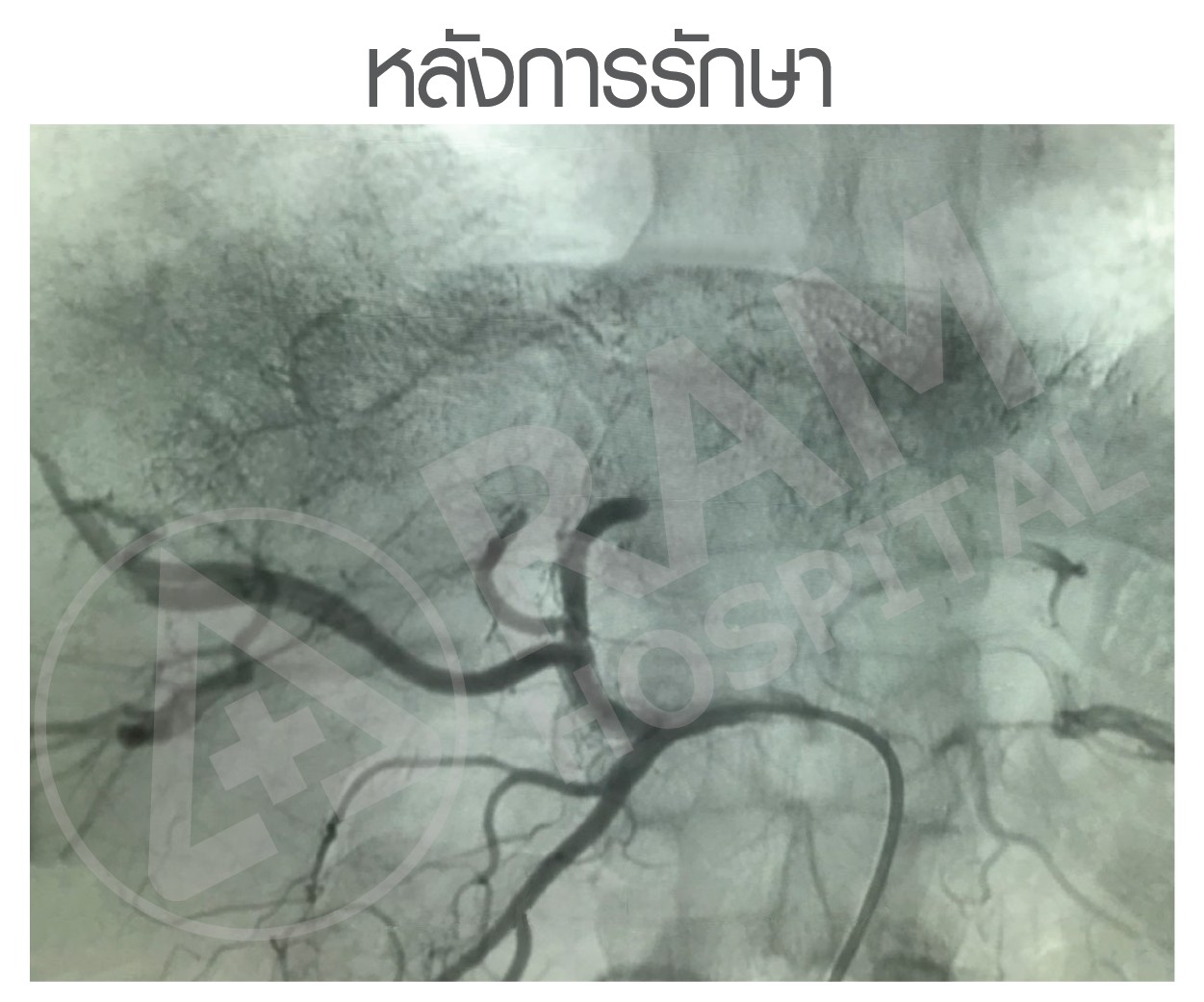รักษามะเร็งตับ tace
