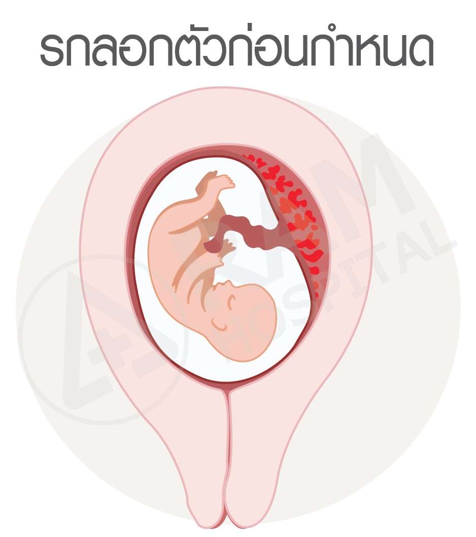 ครรภ์เป็นพิษ