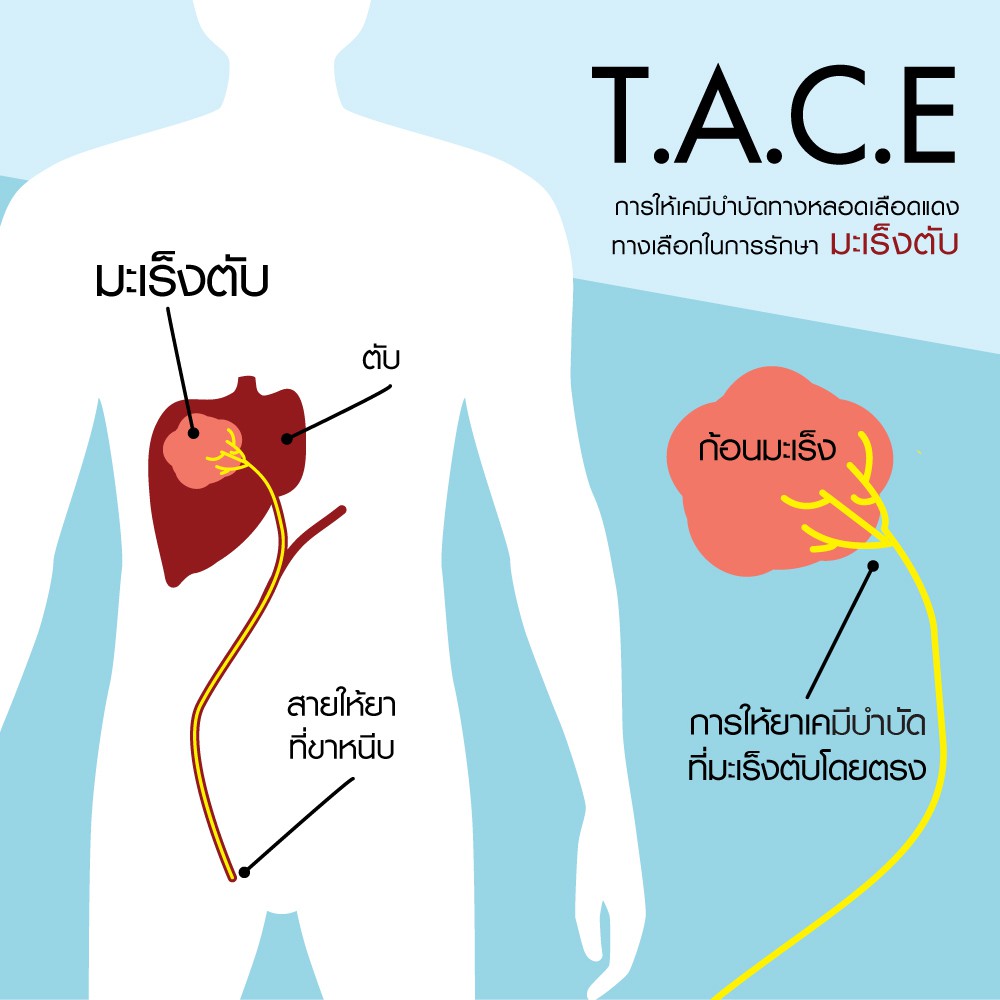 รักษามะเร็งตับ tace