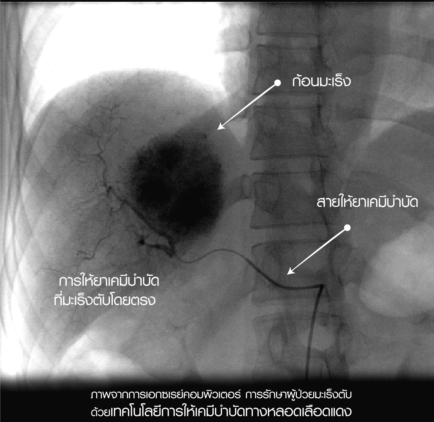 รักษามะเร็งตับ tace
