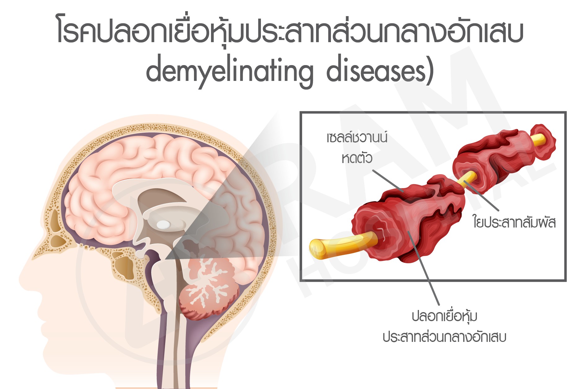 ใบหน้ากระตุกครึ่งซีก