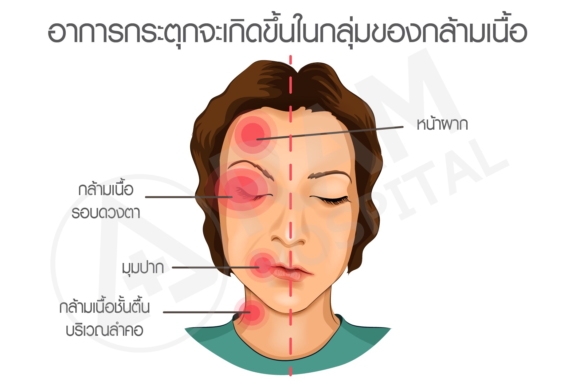 ใบหน้ากระตุกครึ่งซีก