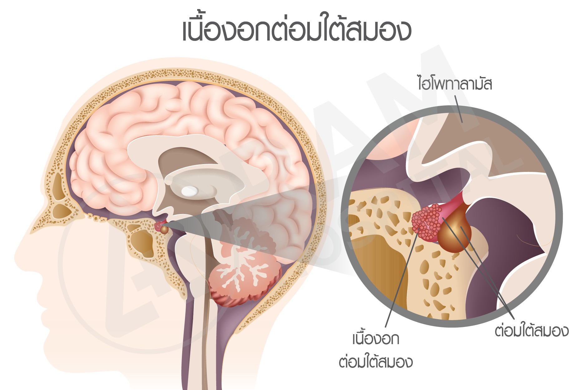 เนื้องอกต่อมใต้สมอง