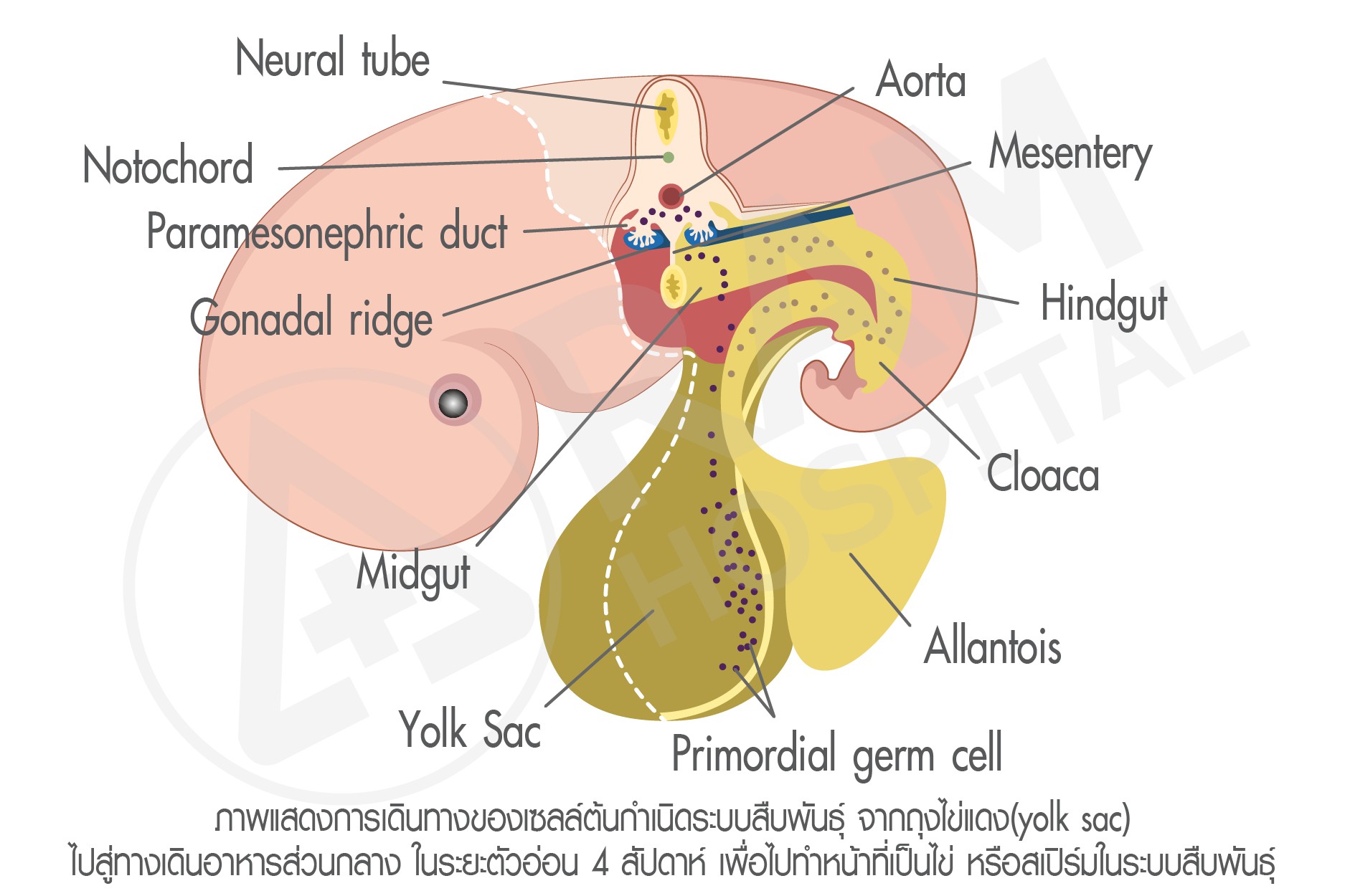 เนื้องอกรังไข่
