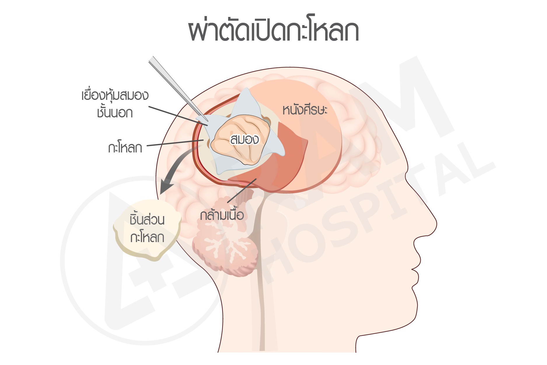 เนื้องอกต่อมใต้สมอง