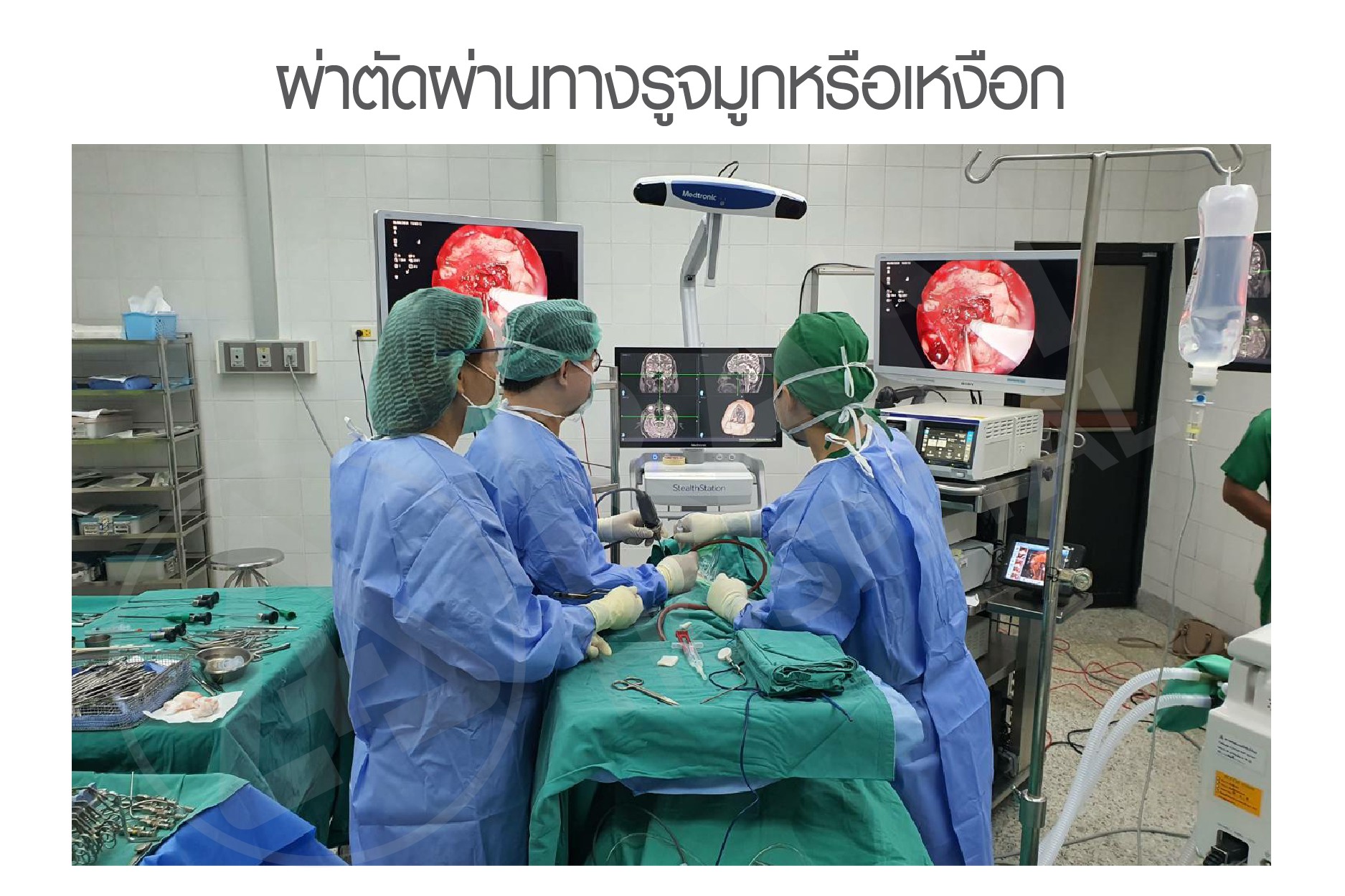 เนื้องอกต่อมใต้สมอง
