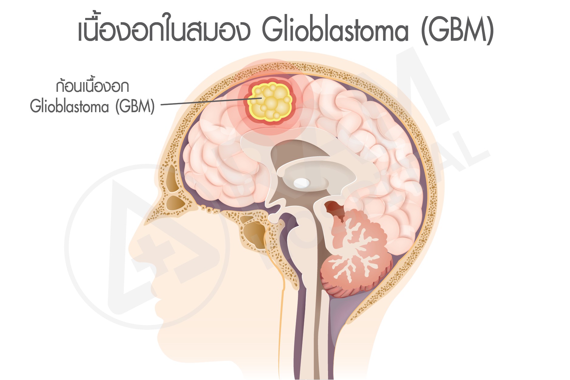เนื้องอกมะเร็งสมอง