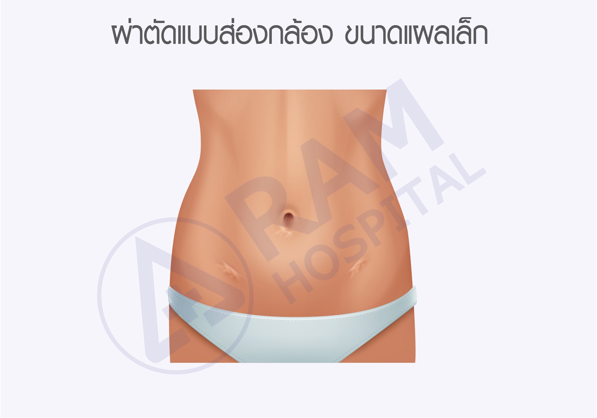 ผ่าตัดส่องกล้องนรีเวช