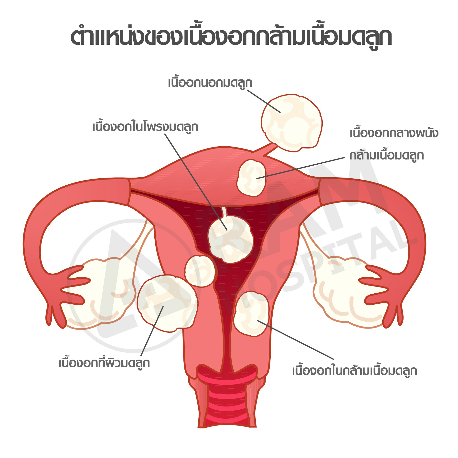 ผ่าตัดเนื้องอกมดลูก ส่องกล้อง
