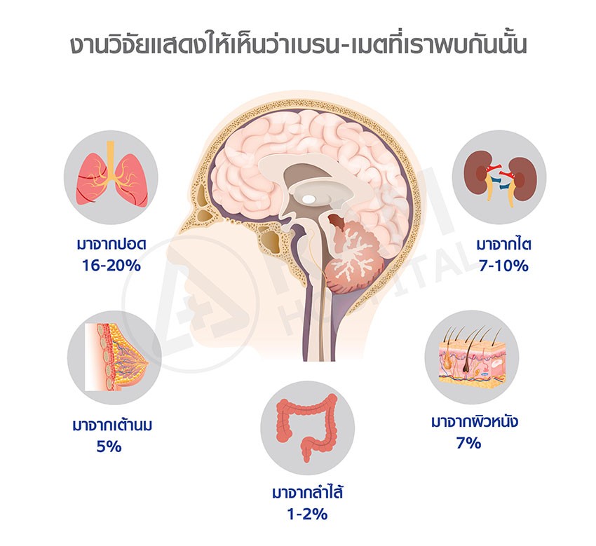 เนื้องอกสมองจากมะเร็ง