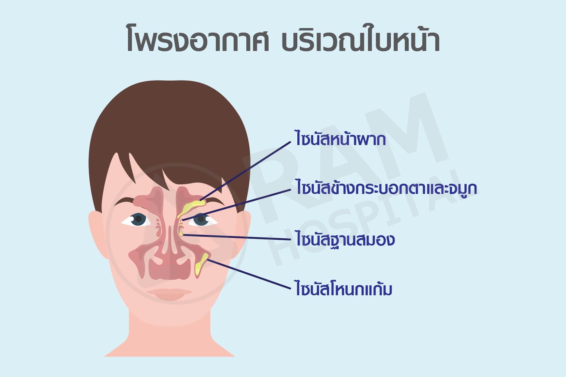 ไซนัสอักเสบ
